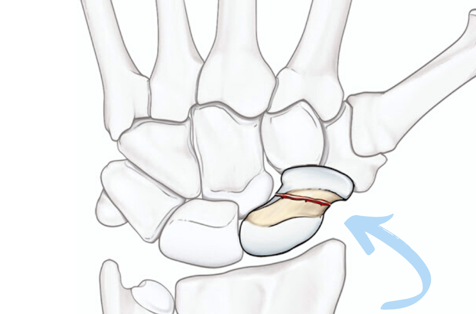 Le ossa del carpo, i metacarpi, le due filiere del carpo, il radio e l'ulna. Inoltre lo scafoide presenta una linea rossa di frattura indicata da una freccia azzurra