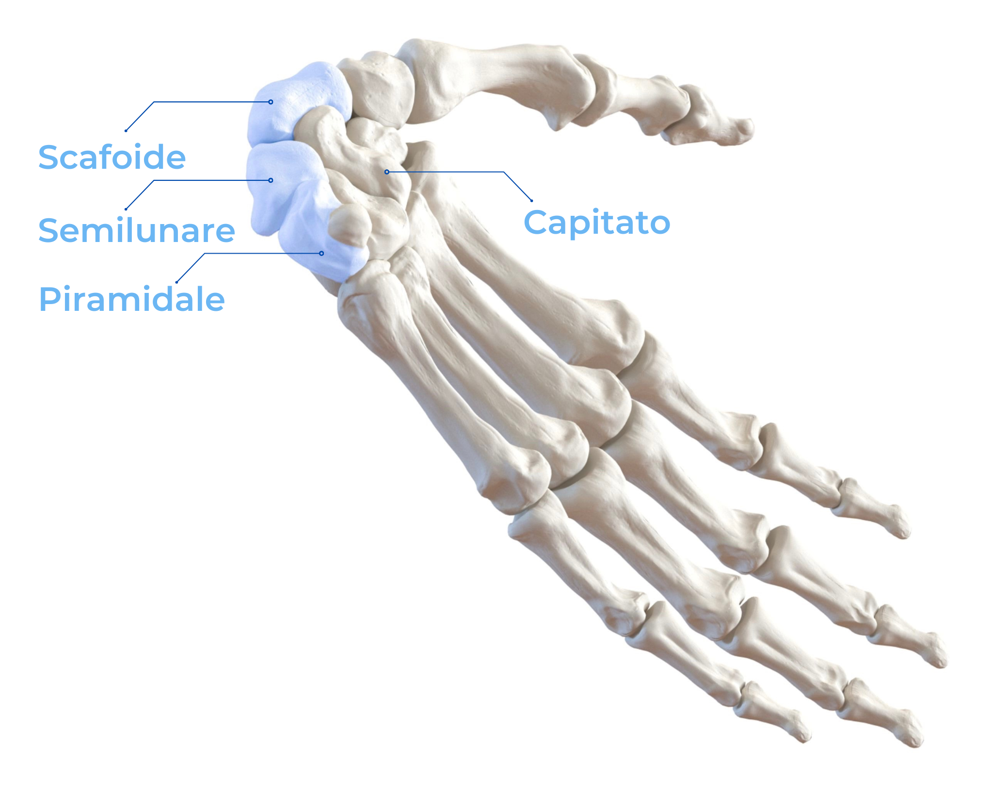Le ossa del carpo viste dal lato ulnare, sono evidenziate le ossa che vengono rimosse nella resezione della prima filiera del carpo (scafoide, semilunare e piramidale). Per completezza informativa è stato indicato anche il Capitato.