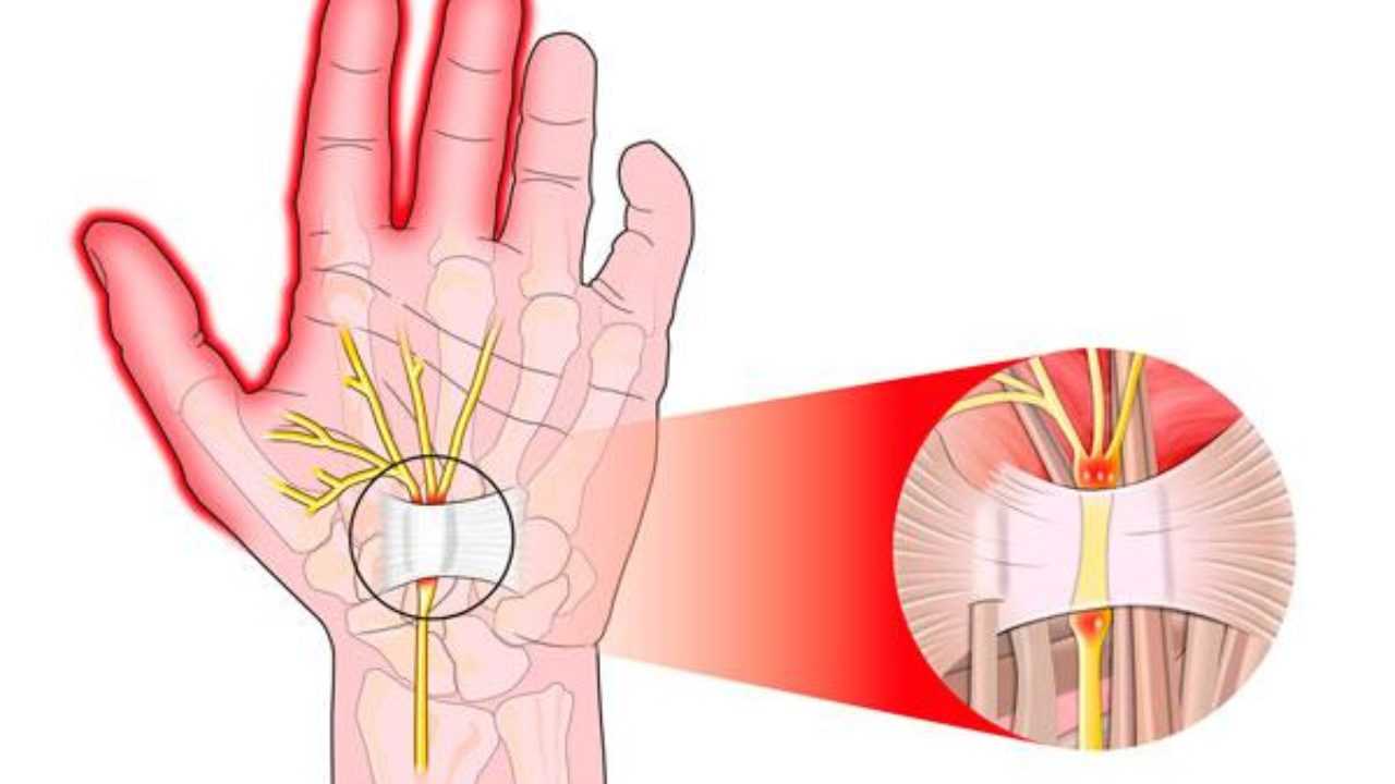 Una mano con il decorso del Nervo Mediano, in particolare si nota il legamento traverso del carpo e l'intrappolamento del Nervo Mediano da parte di quest'ultimo