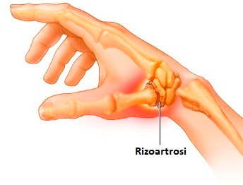 Una mano e le sue ossa, in particolare l'artrosi a carico dell'articolazione trapezio-falangea del pollice