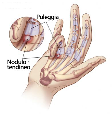Una mano, in particolare i tendini dei flessori e le puleggie. Si nota un nodulo tendine a livello del quarto dito che lo blocca in flessione